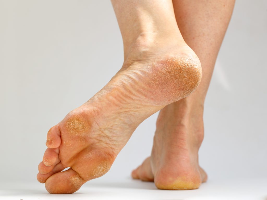 Callus Treated in Garland