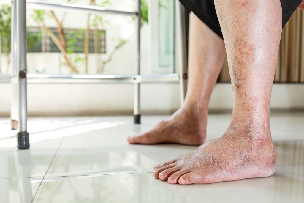 Diabetic Foot Care in Garland